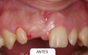 implantes dentales. caso unico