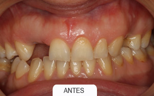 implantes dentales. puente de 2 piezas