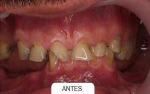 implantes dentales. rehabilitaciones complejas