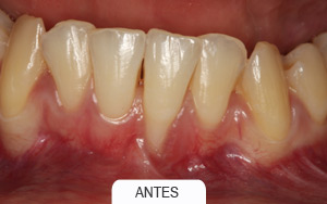 implantes dentales. puente de 2 piezas