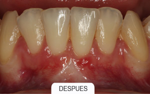 implantes dentales. puente de 2 piezas